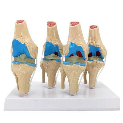 医学科学のためのヒト膝関節病理学モデルの解剖学実証