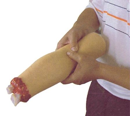 トラウマ 看護 モデル 上肢の傷治療のための腕切断と血止まり