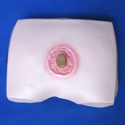 臨床看護師訓練モデル 骨折症の段階 潰瘍 病院の看護