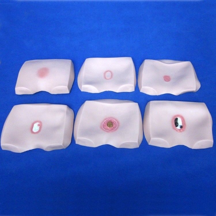 臨床看護師訓練モデル 骨折症の段階 潰瘍 病院の看護